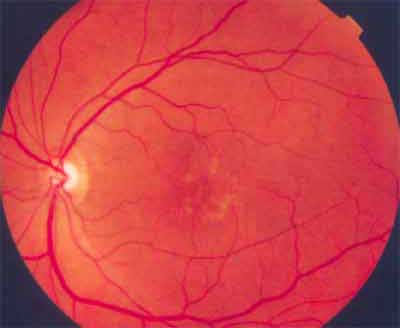 Branch Retina Vein Occlusion