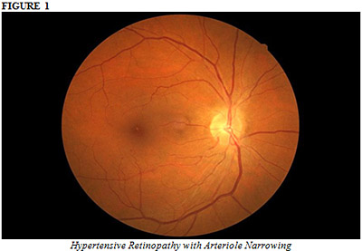 Hypertensive Retinopathy with Arteriole Narrowing